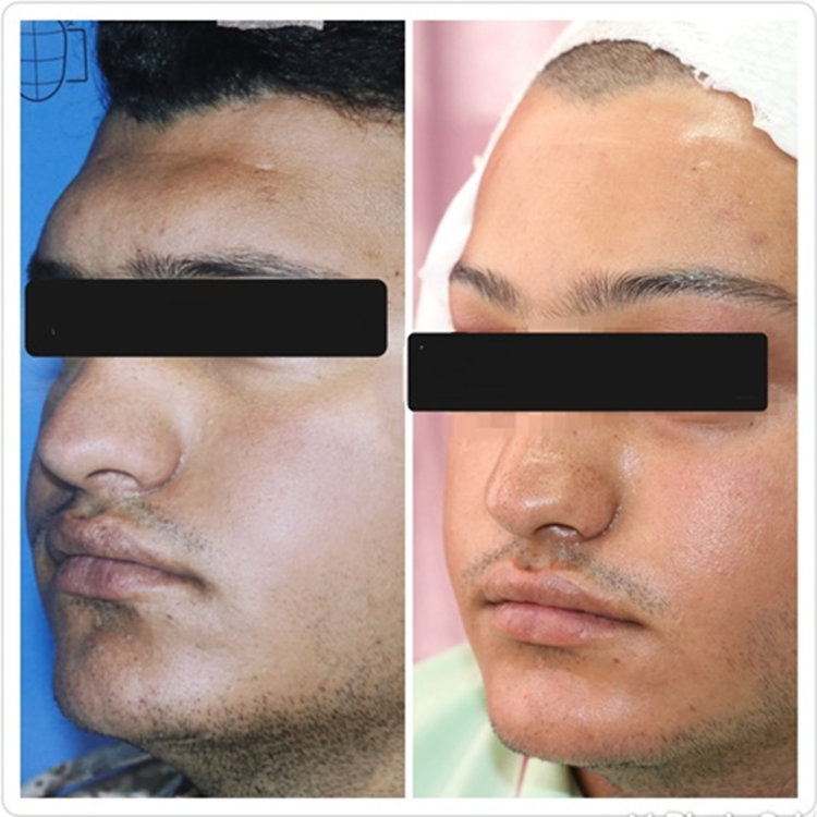 Forehead Contouring Surgery Performed in Shiraz for the First Time